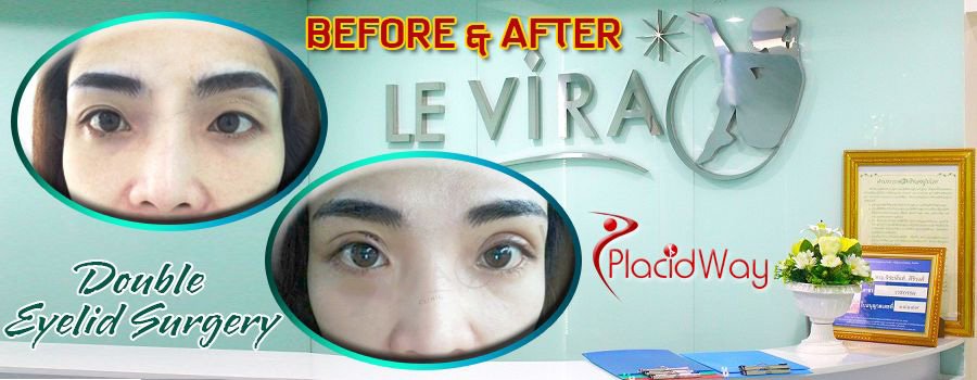 Before and After Double Eyelid Surgery in Bangkok, Thailand